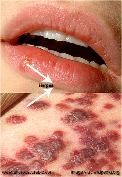 about herpes